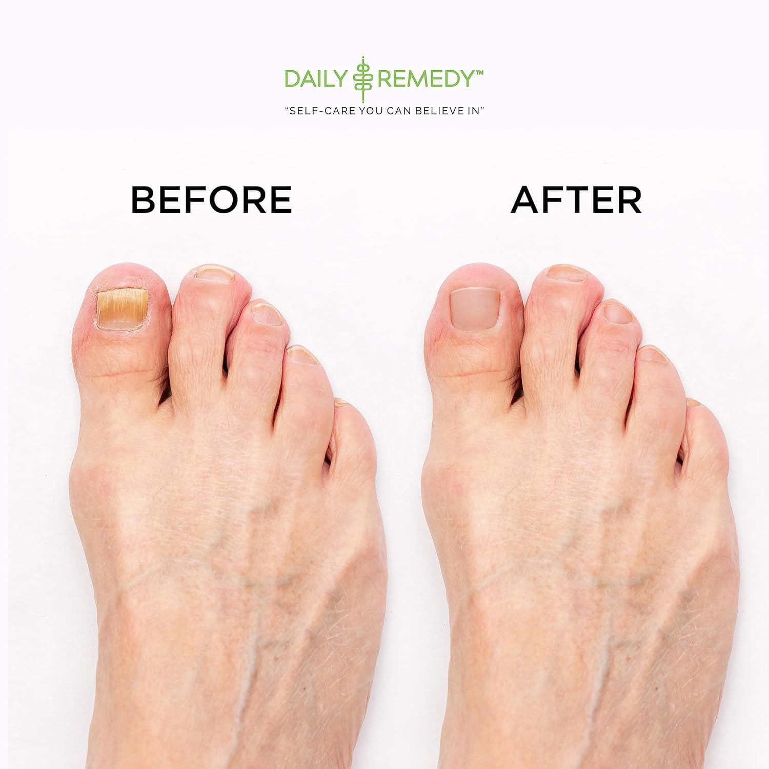 EXTRA STRENGTH Tea Tree Oil Foot Soak with Epsom Salt - Made in USA - for Toenails, Athlete's Foot, Itchy Feet, Stubborn Smelly Foot Odor, Pedicure, Foot Calluses & Soothes Sore Tired Achy Feet-2 Pack